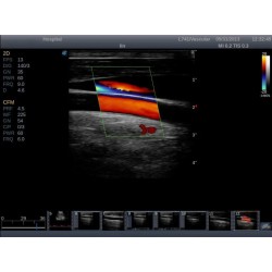 Medical Trolley 4D Color Doppler Sonoscape S11 Ultrasound