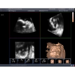 Medical Trolley 4D Color Doppler Sonoscape S11 Ultrasound